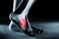 Causes and Strategies for Treatment of Stress Fractures