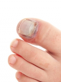 Symptoms and Causes of a Broken Toe