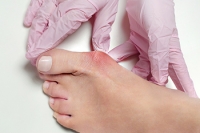 Treatment for Bunions Including Surgery