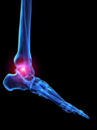 Podiatrists Can Treat Arthritis in the Feet