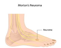 Where Is Pain from Morton’s Neuroma Located?