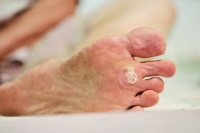 Where Are Plantar Warts Located?
