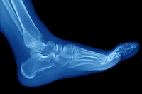 Causes of Stress Fractures