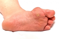 Possible Ways to Prevent Gout