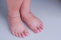 Conditions That May Cause Swollen Ankles