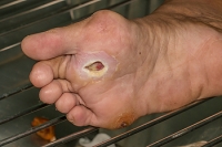 Possible Causes of Wounds on the Feet
