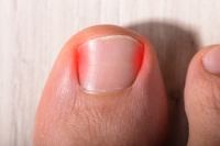 What Are the Causes of Ingrown Toenails?
