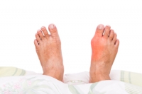 Gout Causes Severe Pain And Discomfort